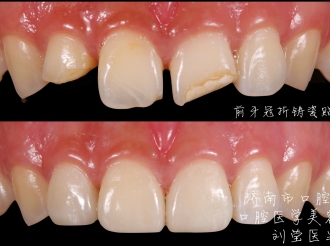 前牙缺损树脂修复病例
