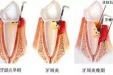 牙周病，你该引起重视的疾病