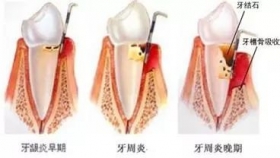 牙周病，你该引起重视的疾病