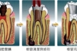 做完根管治疗后的牙齿，有必要做牙冠吗？