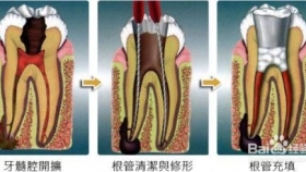 做完根管治疗后的牙齿，有必要做牙冠吗？