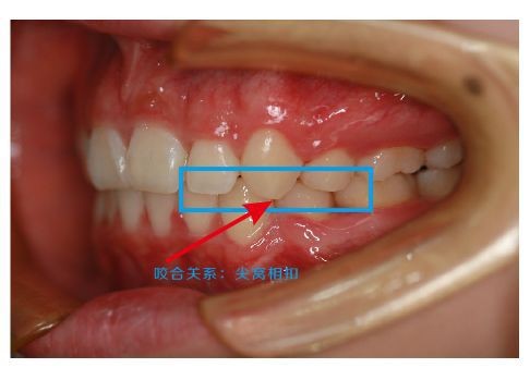 正常咬合:上排牙齿的窝,对下排牙齿的尖,而非正常的咬合属于尖对尖