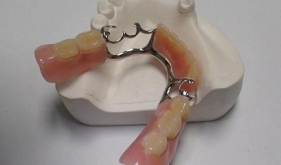 牙齒缺失常見的修復方式有幾種？