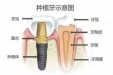 为什么种植牙很坚固却不能随意啃咬硬物？