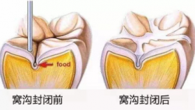 “窝沟封闭”那些事儿