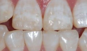你知道什么是氟斑牙嗎？