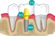 种植牙，是种下一颗种子，长出一颗牙齿吗？