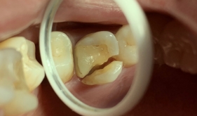 根管治疗后为什么建议做牙冠？