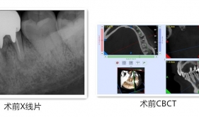 显微根尖手术—保留患者天然牙最后一搏