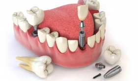 济南市口腔医院修复专家告诉您种植牙松动了怎么办