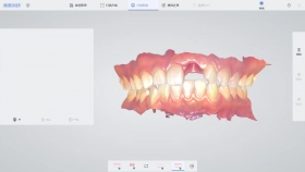 口腔数字化治疗方案之一3D口扫