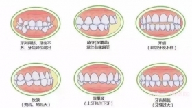 怎样可以预防孩子错合畸形？