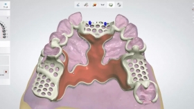 3分钟带您了解激光3D打印钛金属可摘局部义齿