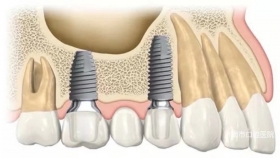 为什么选择种植牙？