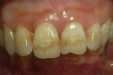 牙釉质发育不全是什么？