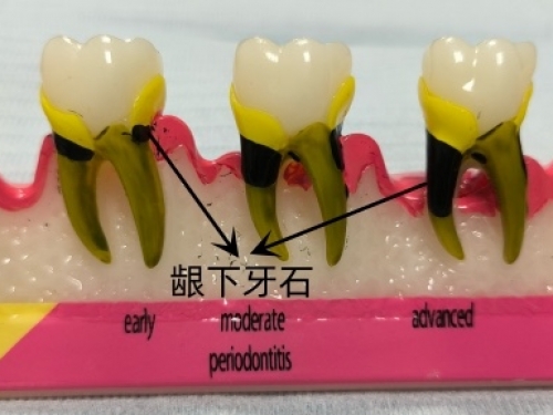 每年洗牙能治好牙周病吗？