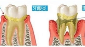 “老掉牙”不是必然，“牙周病”才是元凶