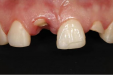 即刻种植修复让患者免受长期缺牙的困扰