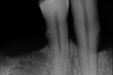 依靠显微根管技术留住根管变异患者的天然牙