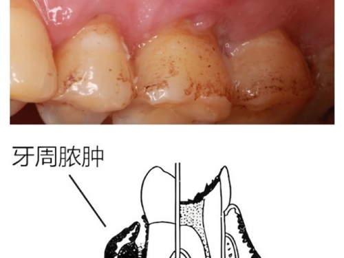 春暖花开，警惕牙龈鼓包