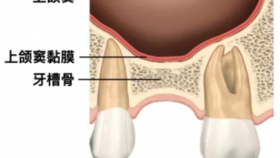 种植牙上颌窦底提升：打开口腔健康的新“高度”