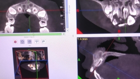 小儿多生牙为什么要拍摄CBCT？