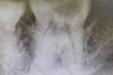 济南市口腔医院牙体牙髓病1科成功治疗1例“奔跑中的牙齿”