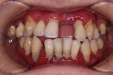 牙周炎——牙齿缺失的“元凶”