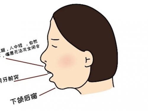 您了解下颌后缩吗？