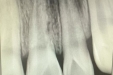 济南市口腔医院牙体牙髓病1科成功保存因外伤导致牙根外吸收穿孔患牙