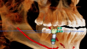 什么是口腔CBCT，种牙为什么要拍CBCT片？