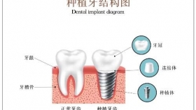种植牙，是种下一颗种子长出一颗牙齿吗？