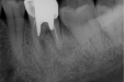 重点专科：市口腔医院牙体牙髓病2科利用显微根尖外科手术治疗根尖再感染