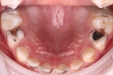 跨省慕名千里求医，济南市儿童口腔2科全麻下无痛修复患儿龋齿