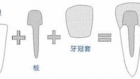 把“根”留住--CAD/CAM一体化纤维桩核