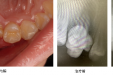 市口腔医院牙体牙髓病2科利用显微根管技术完成“双生牙”根管治疗