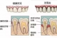 别让塞牙毁了口腔健康