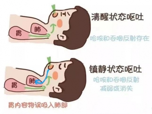 麻醉前为什么要禁食禁水？
