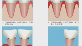 关爱牙周，守护口腔健康