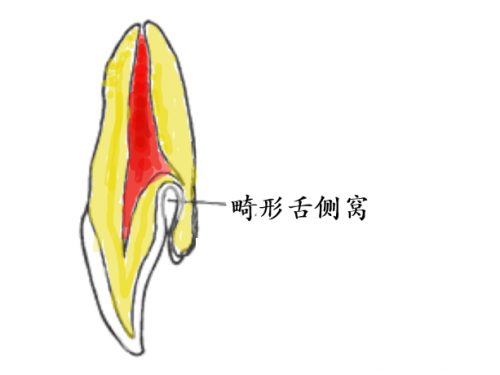 畸形舌侧窝有什么危害？