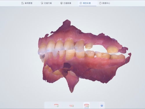 口腔数字化修复量齿定制，患者获诊疗新体验