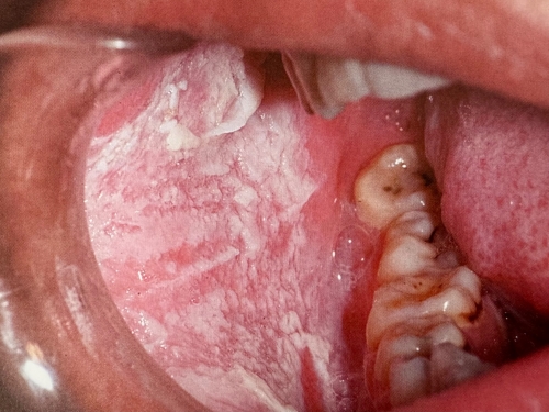 口腔白色海绵状斑痣：一种良性口腔黏膜病