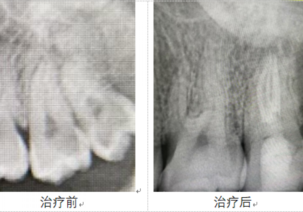 市口腔医院牙体牙髓病2科利用显微根管技术完成复杂根管治疗