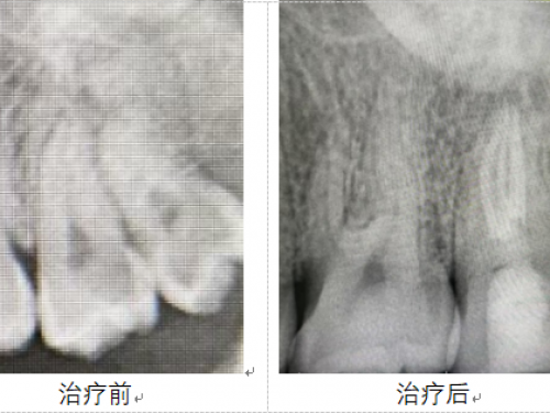 市口腔医院牙体牙髓病2科利用显微根管技术完成复杂根管治疗