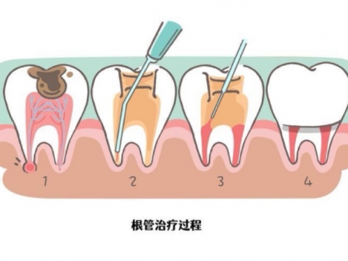 为什么乳牙要做根管治疗？