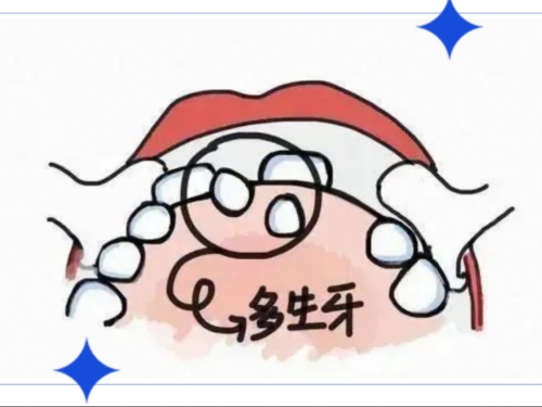 隐藏的“多余牙”——儿童多生牙的发现与防治科普